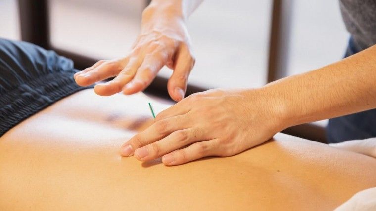 acupuncture