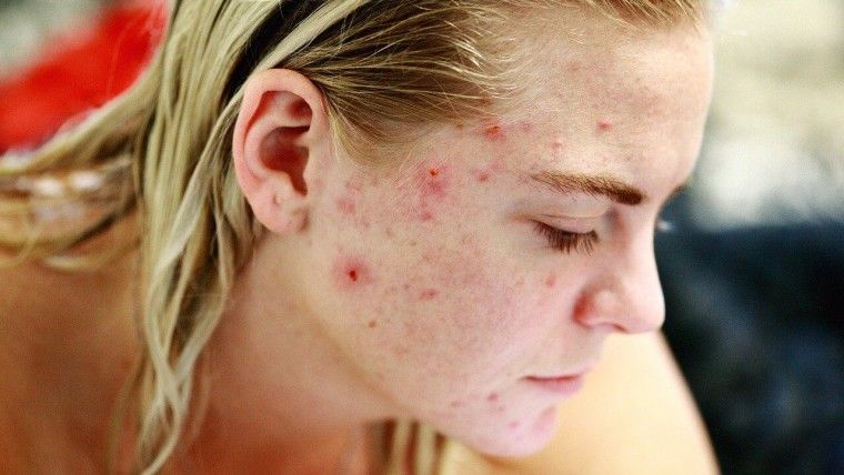 home remedies to get rid of acne