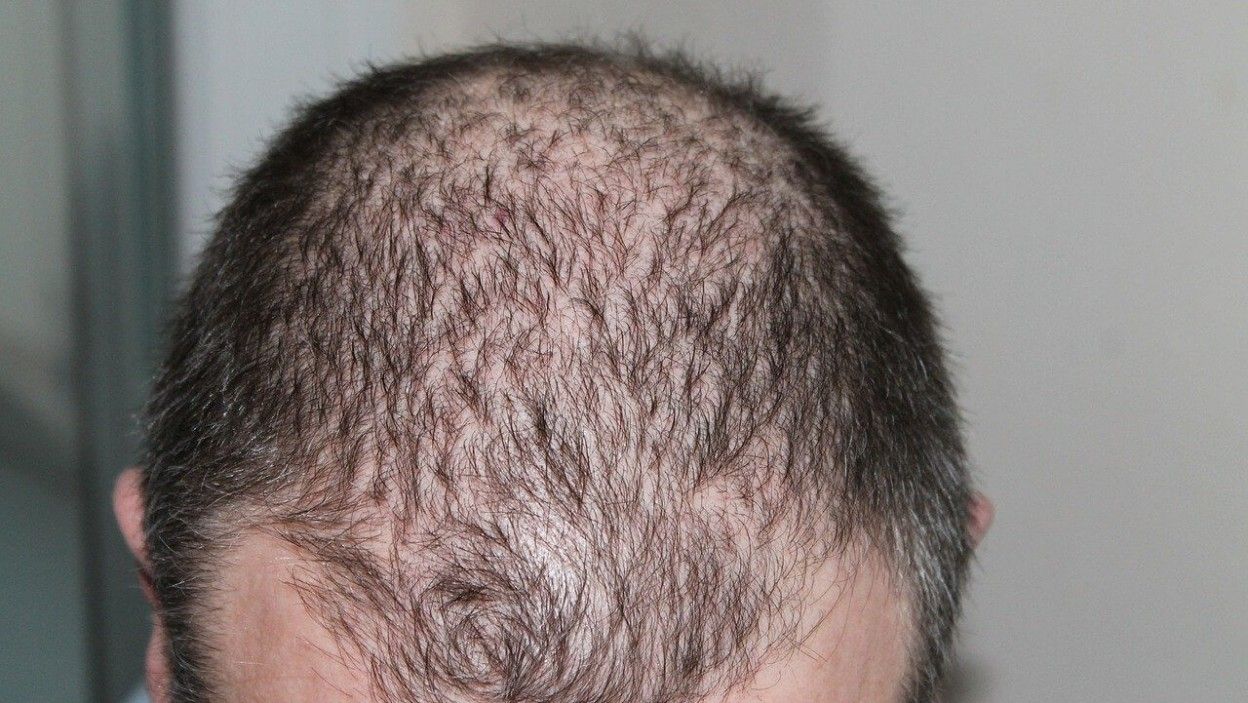 hair loss in men